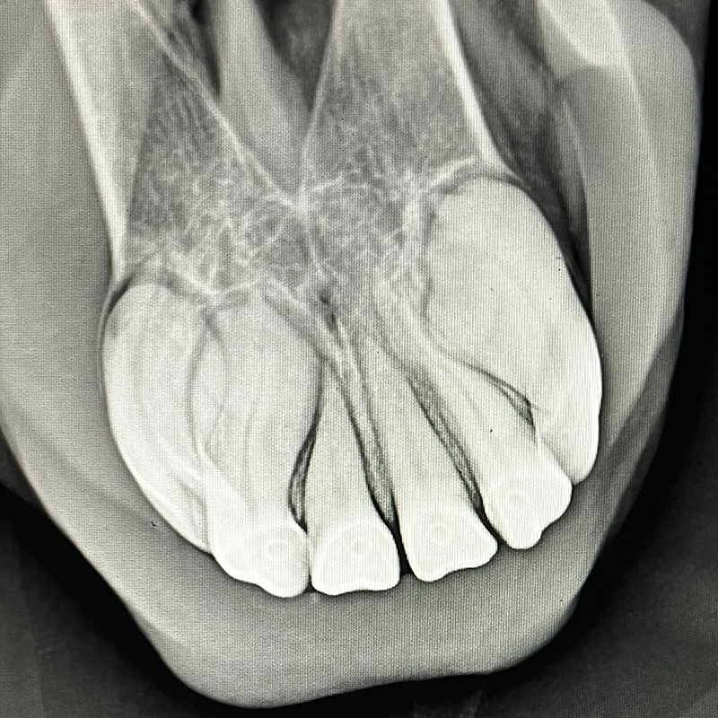 Oberkieferschneidezähne mit EOTRH