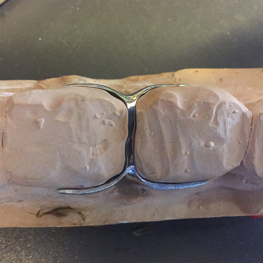 Chronic diastema treatment using a spacer clamp