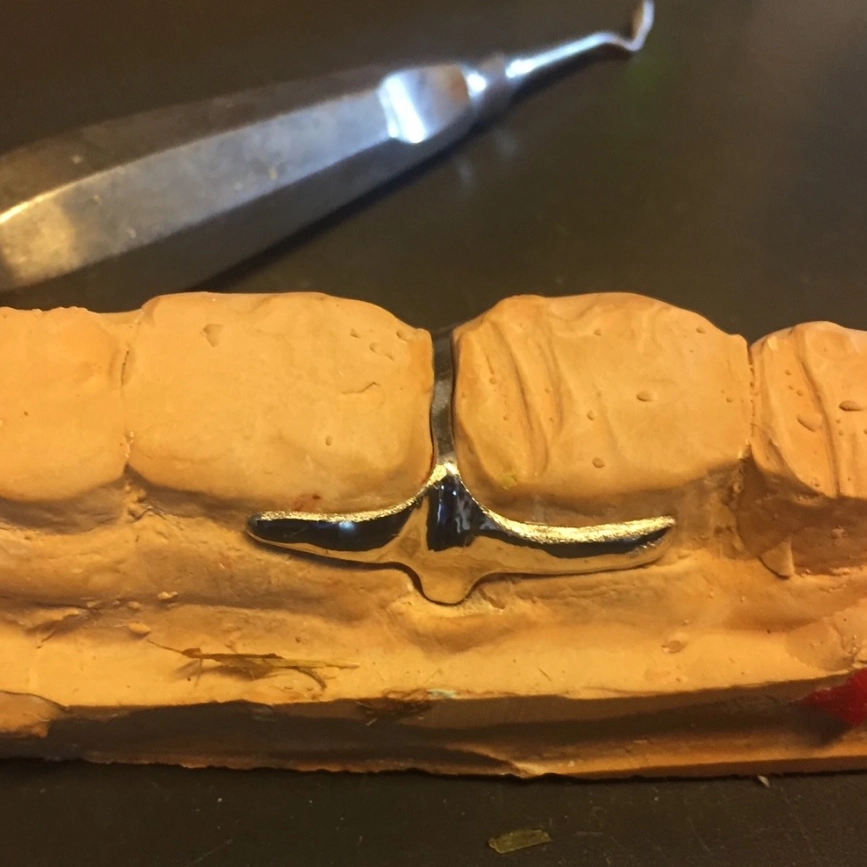 The spacer clamp prevents persistent feed impaction