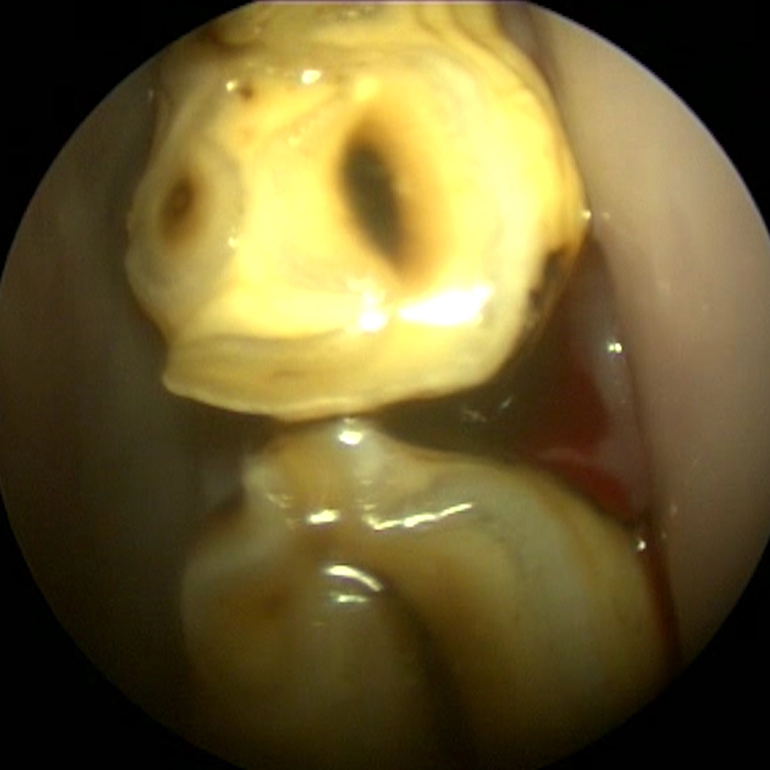View of a cleaned diastema with an inflamed periodontal pocket (bleeding)