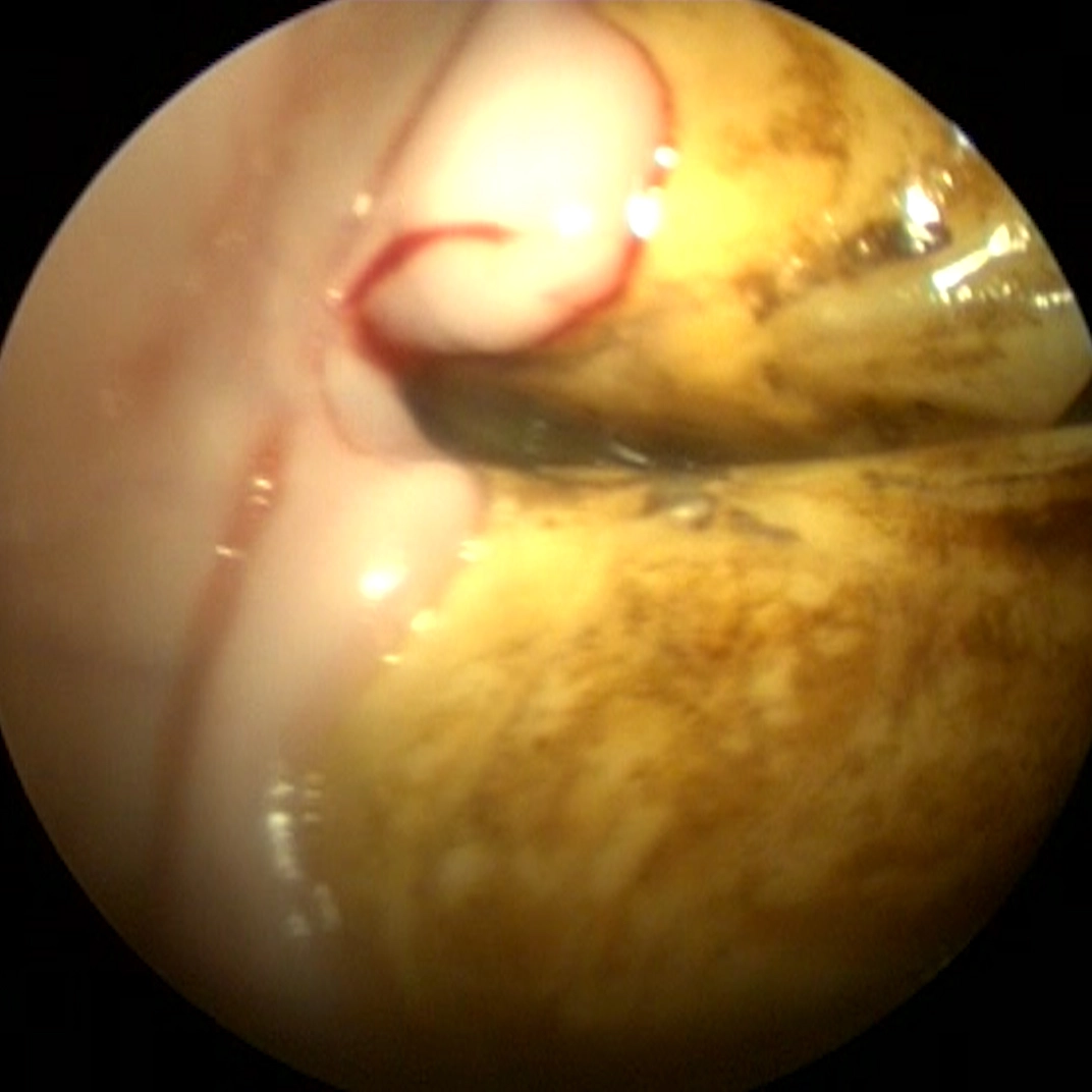 Lateral view of a valve diastema with inflammation and gingival recession
