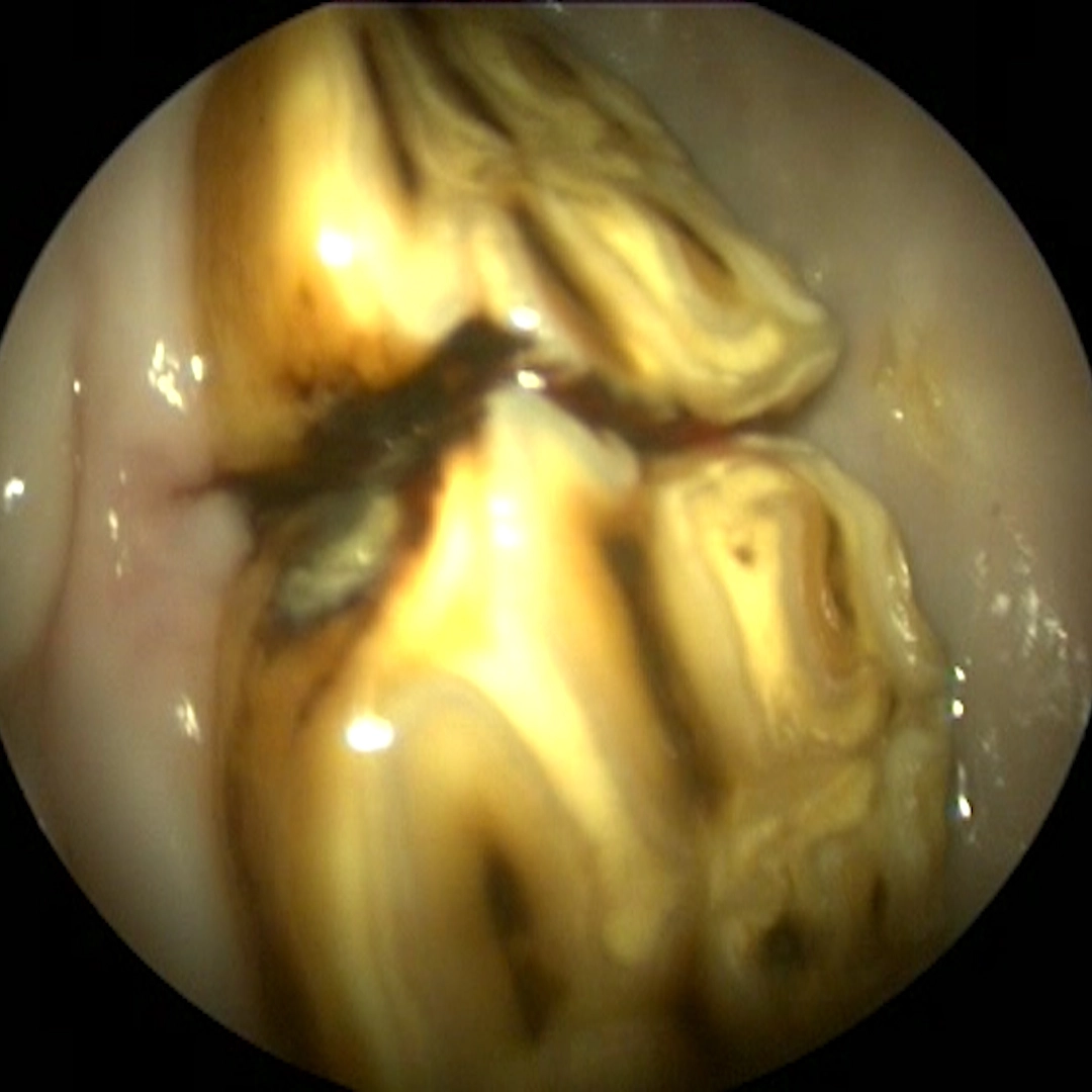 Cleaned, untreated diastema with biofilm (plaque)