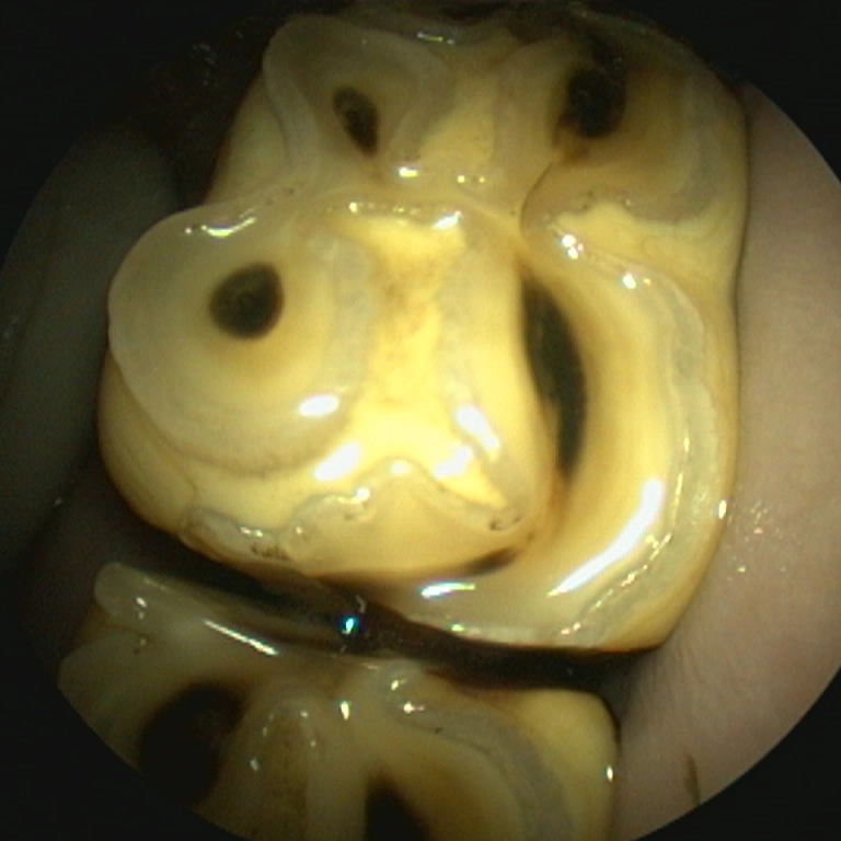 Diastema with feed impaction, trapped feed causing inflammation and pain