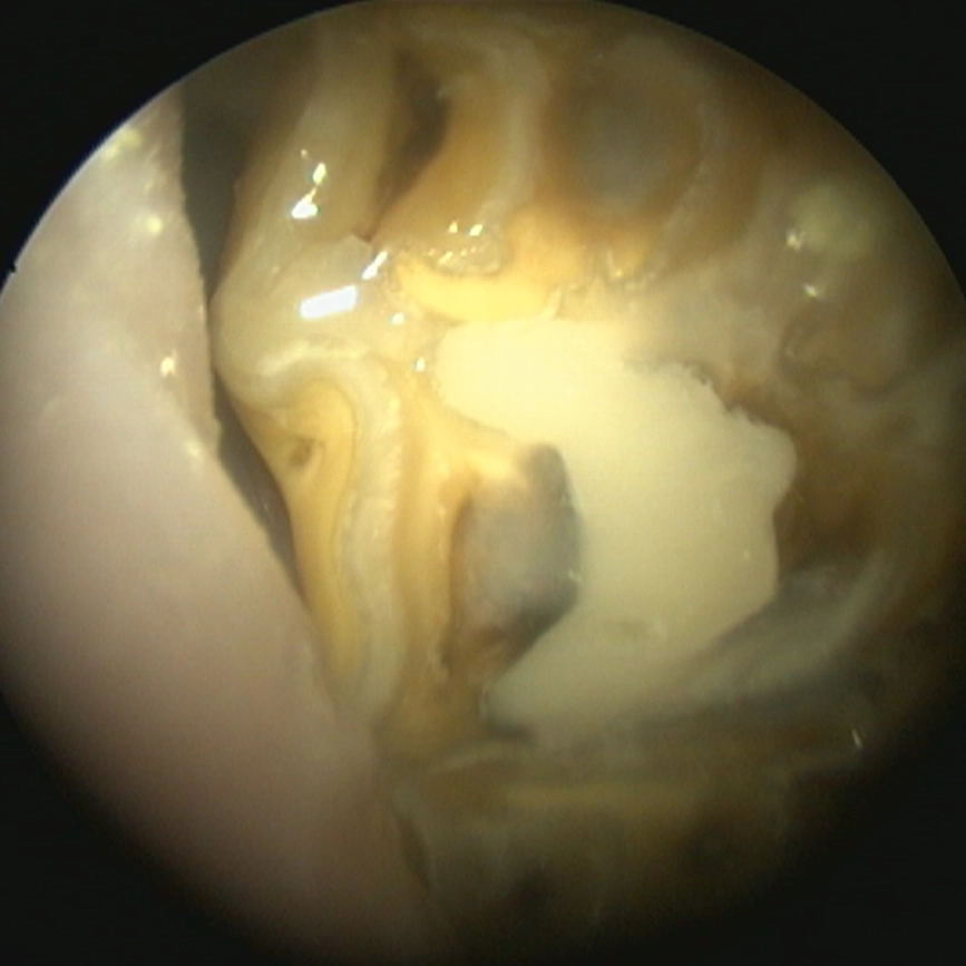 Upper cheek tooth with restored infundibulum