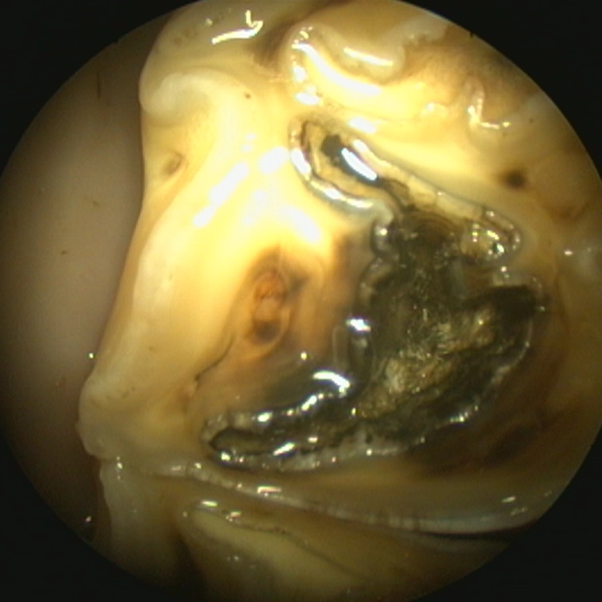 Upper cheek tooth with infundibular cemental hypoplasia