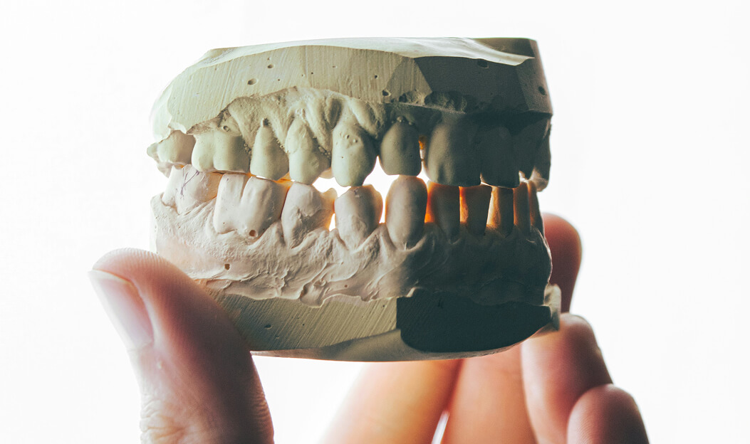 Hand hält ein zahnärztliches Modell eines Ober- und Unterkiefers aus Gips.