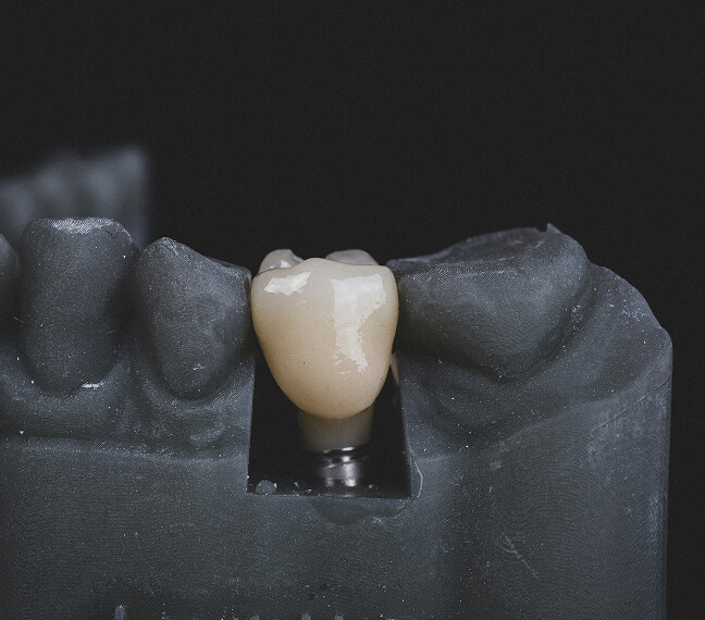 Bild Nahaufnahme eines Zahnersatz-Modells mit einer einzelnen Keramikkrone auf einer Metallbasis.
