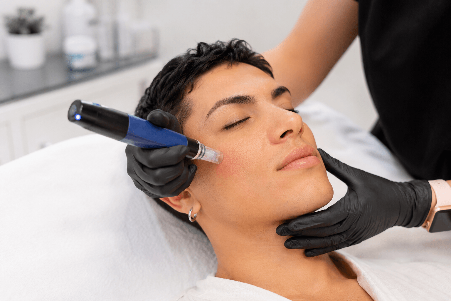 Transgender patient receiving SkinPen microneedling treatment for acne scars and hyperpigmentation in Atlanta, Georgia
