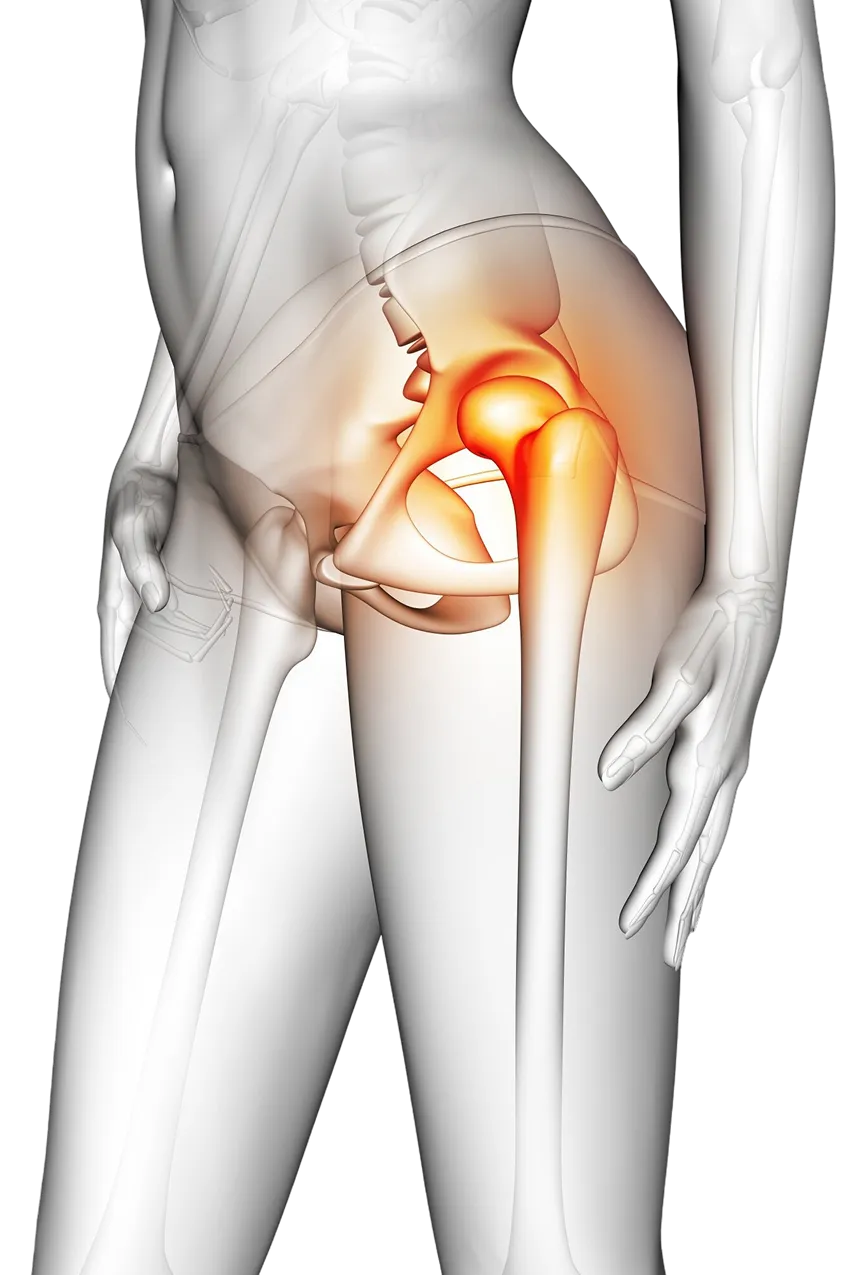 Vue en coupe transparente d'un bassin humain mettant en évidence l'articulation de la hanche avec une zone rouge indiquant une inflammation.