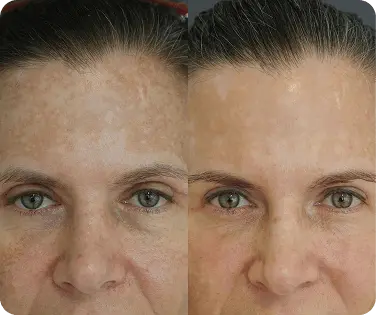 Side-by-side close-up comparison of a woman's face showing significant reduction in skin pigmentation spots and smoother skin texture on the right.