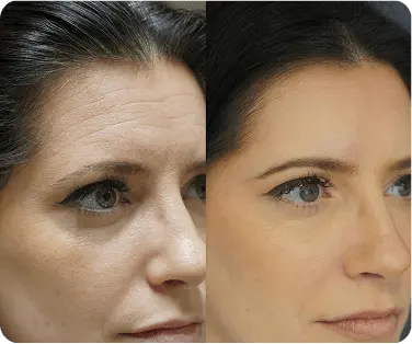 Side-by-side comparison of a woman's face showing visible wrinkles and skin texture on the left, and smoother, clearer skin on the right.