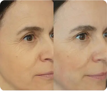 Side-by-side close-up of a woman's face showing reduction of wrinkles around the eye area in the after image.