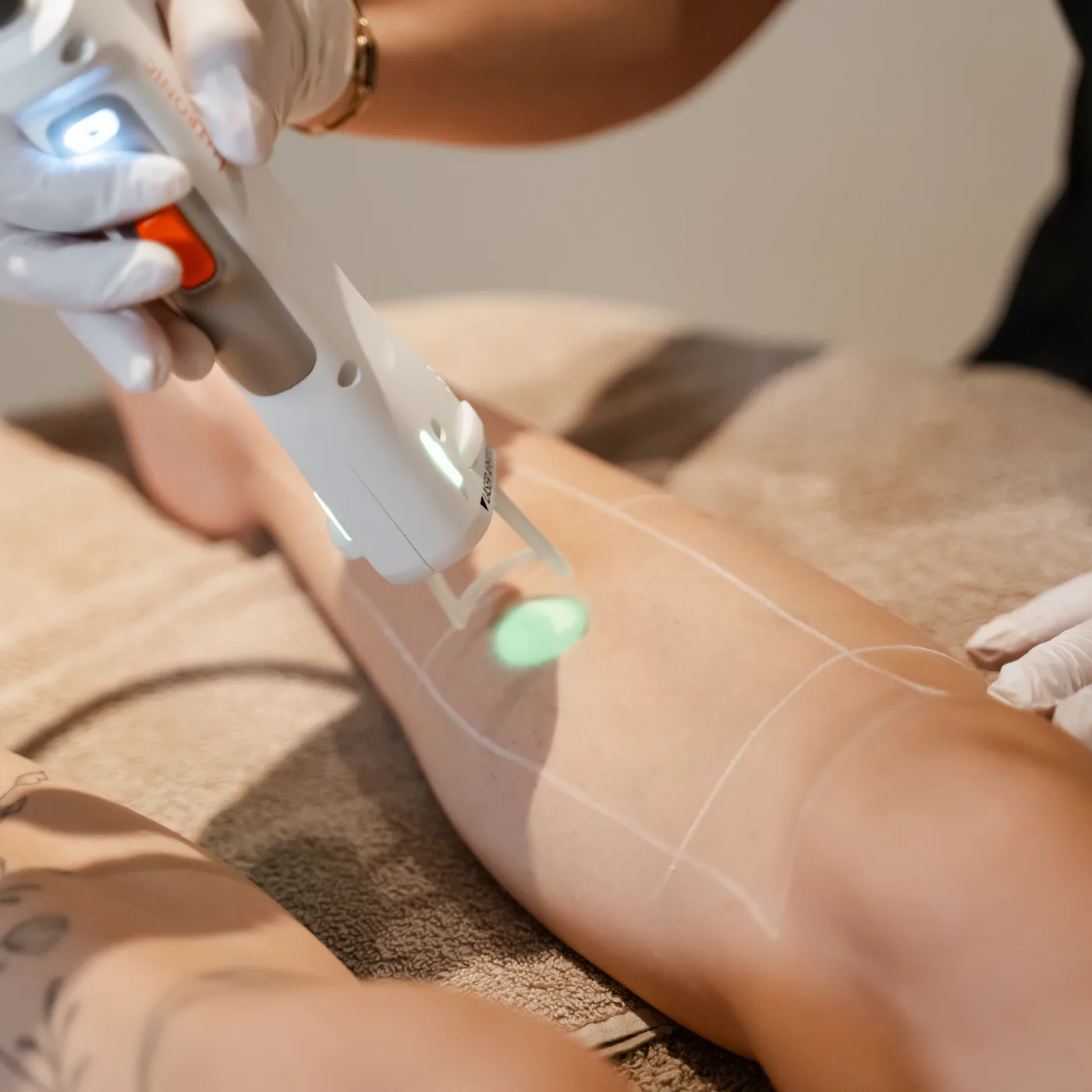 Laserontharen van de benen met de Clarity II laser
