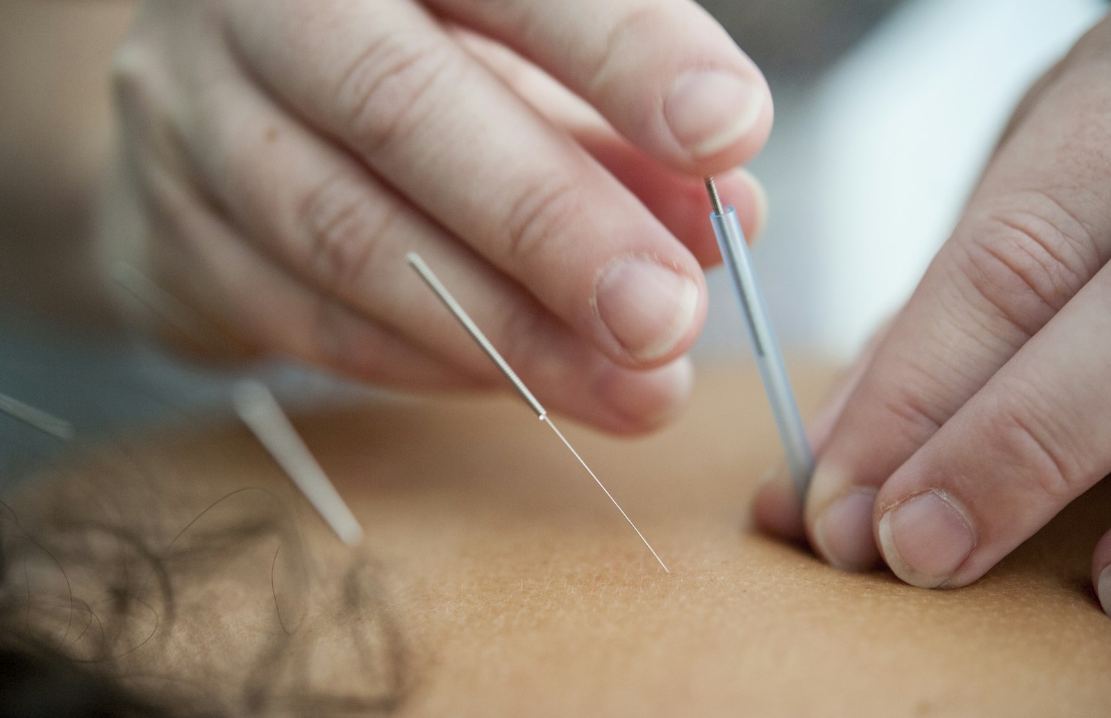 Aiguilles d'acupuncture