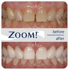 Teeth Whitening