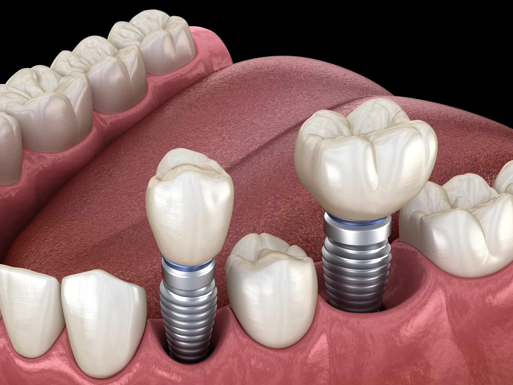 dental implants in Michigan