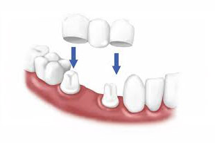  Dental Bridge