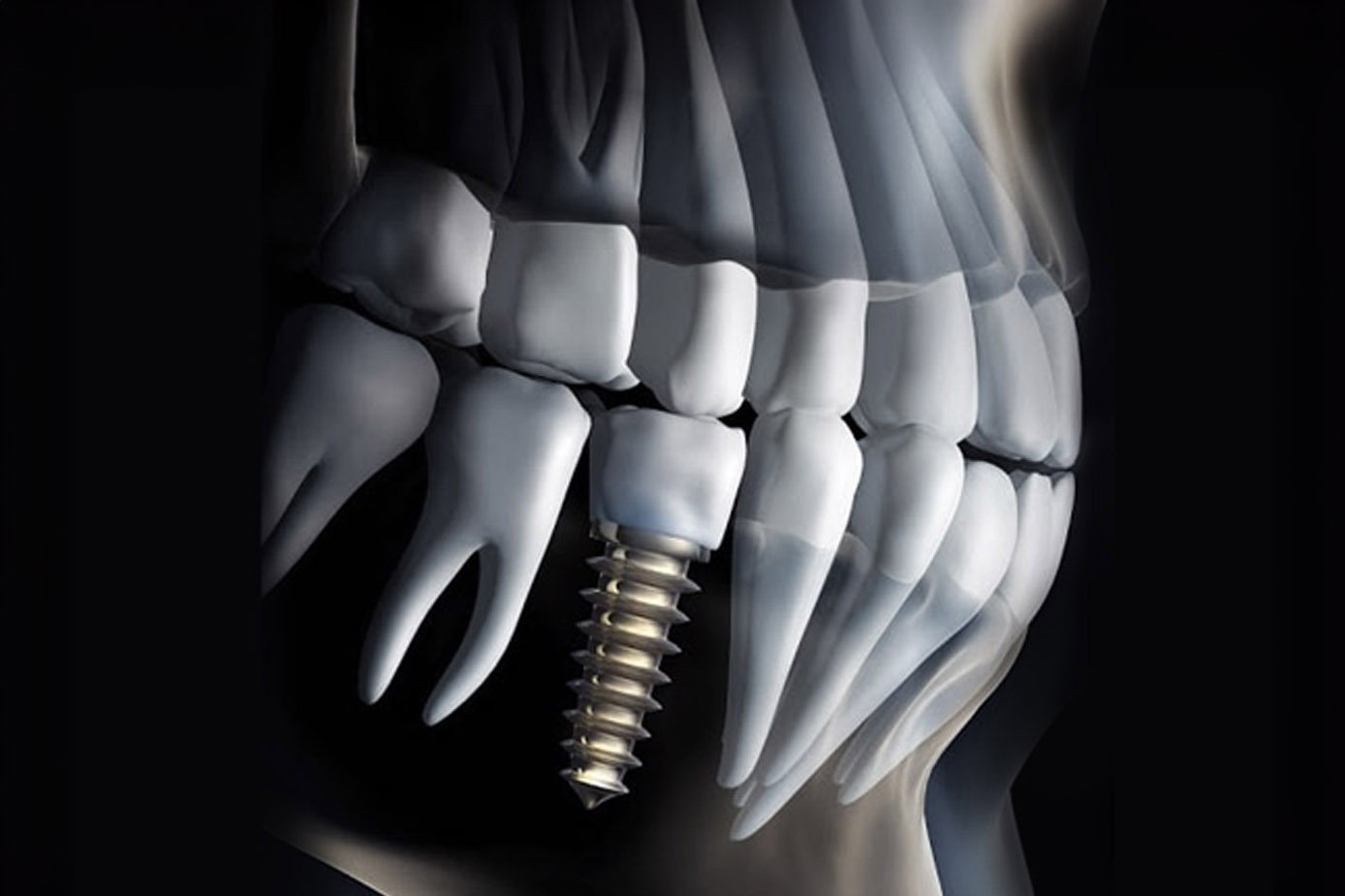 Dental Implants