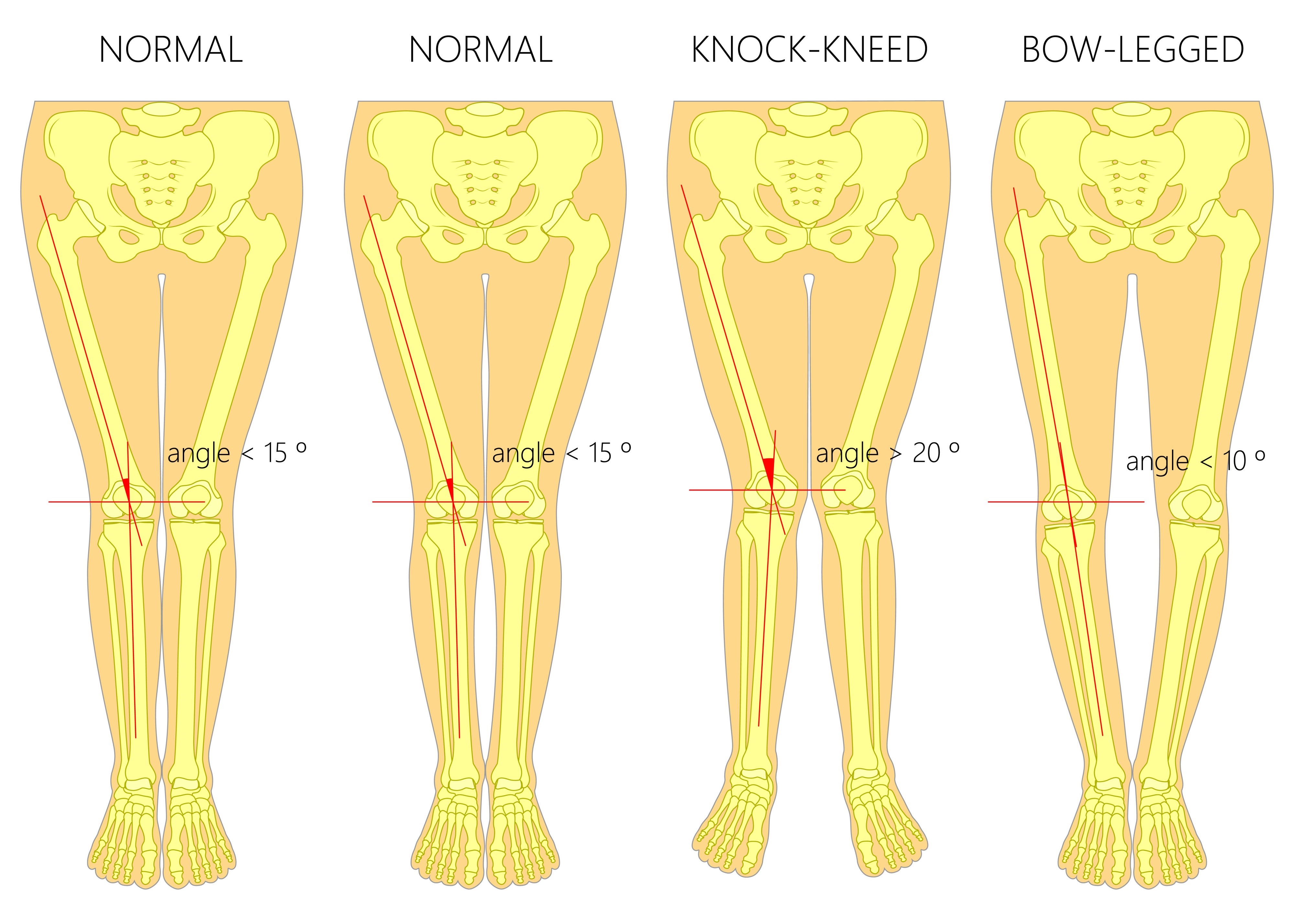 Image of genu varum and genu valgum