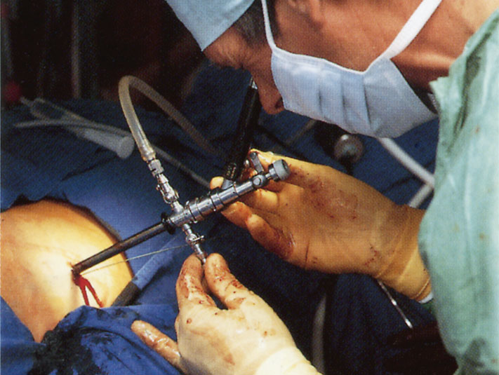 PCNL
