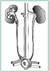 Kidney Stone