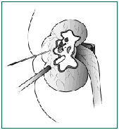 Percutaneous Nephrolithotomy