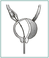 Ureteroscopic Stone Removal