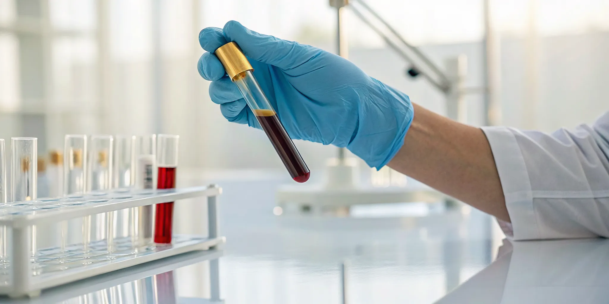 Lab technician holding a blood sample for an alkaline phosphatase test.