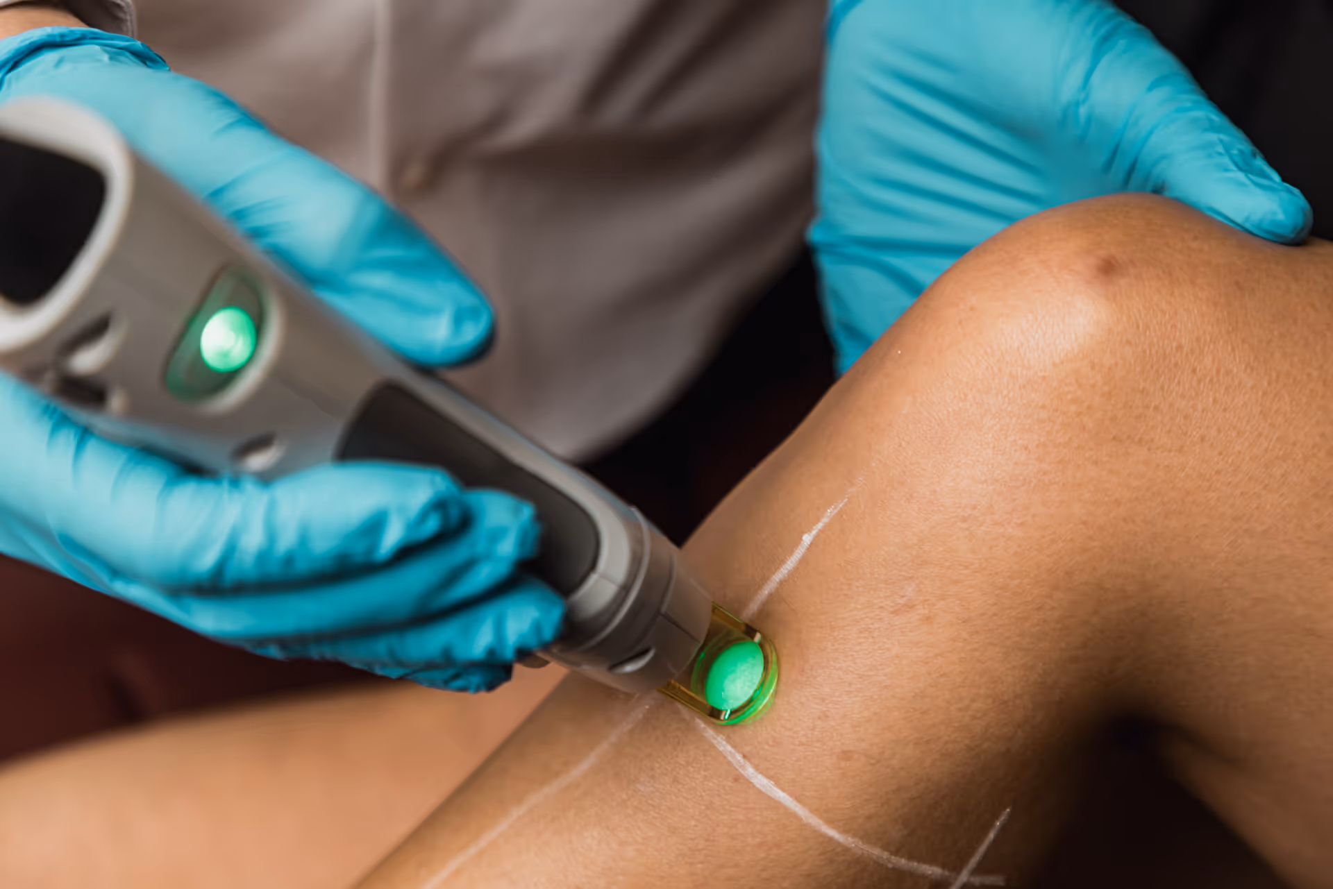 Le Dr Fulmart Reboux tenant un appareil générant une lumière verte sur la peau d'un genou marqué de lignes blanches.