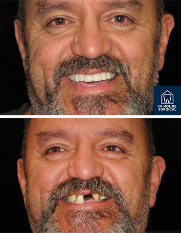 Before-and-after images of a man showing a dental transformation and all on x with missing and damaged teeth turning into a full set of white, healthy teeth.