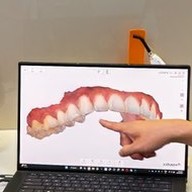 Digital plan of a full set of teeth shown on screen during an implant consult