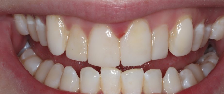 Smile before treatment: chipped, yellowing composite veneers