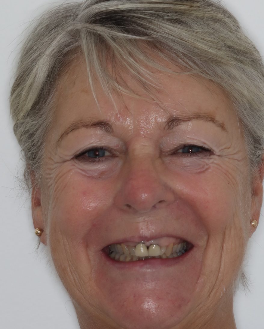 Full face before treatment, showing a gummy smile
