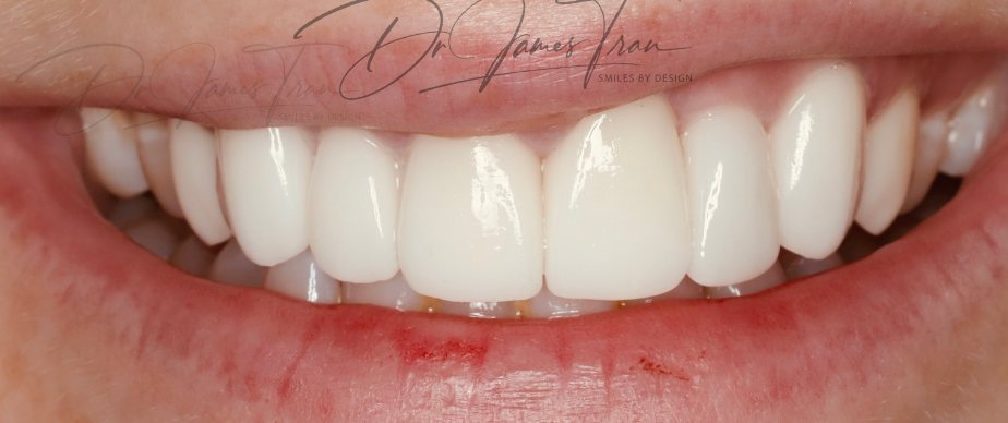 Smile after replacement with ceramic porcelain veneers