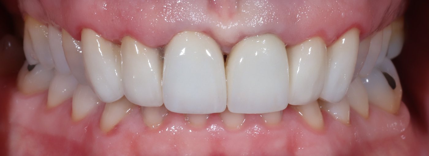 Upper teeth after six new crowns and a gum lift