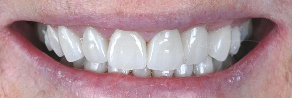 Smile after 10 upper and 10 lower veneers and crowns