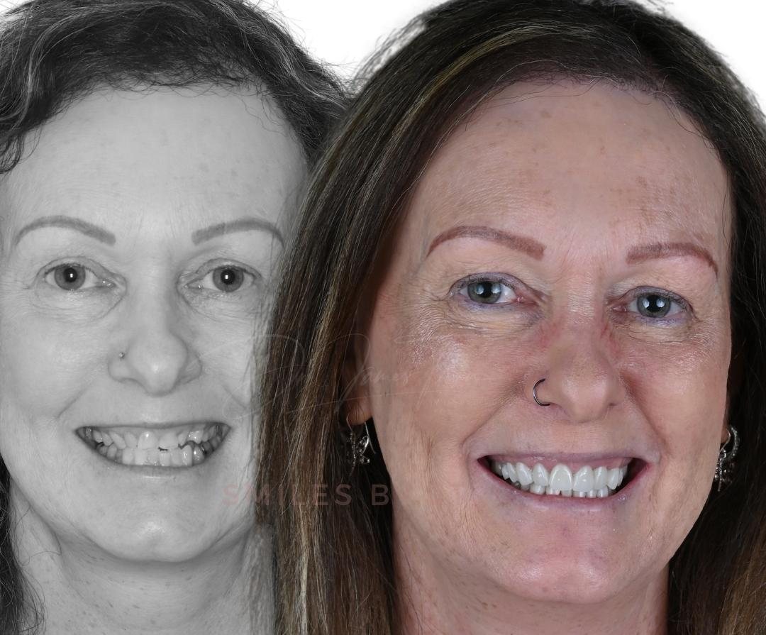 Full-face before and after comparison, taken four weeks apart