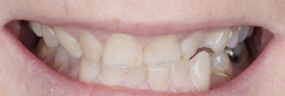 Crowded and missing teeth before veneers and crowns