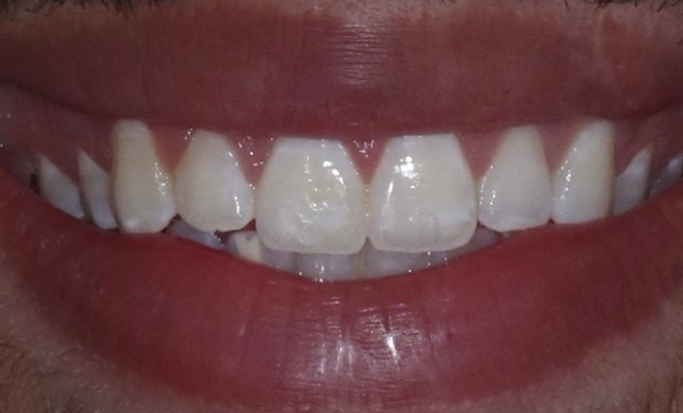 Teeth before conservative veneers, with fluorosis staining