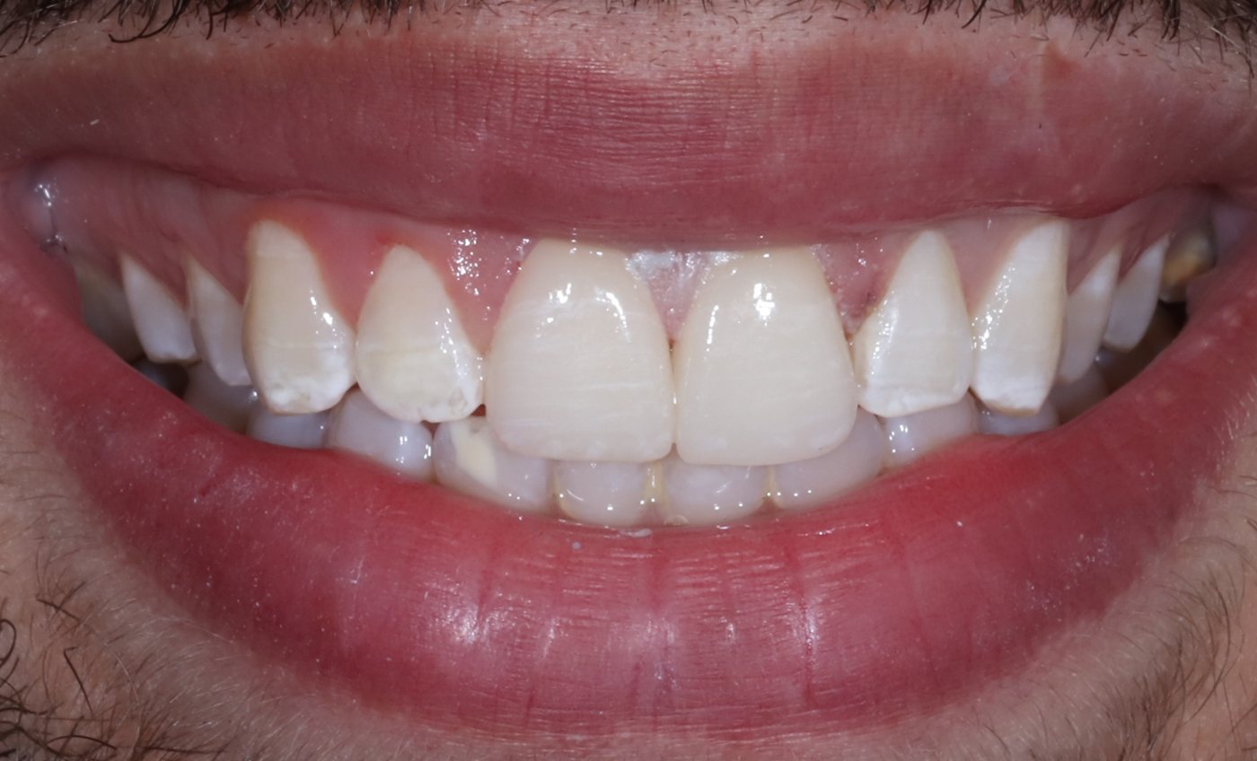 Smile after conservative porcelain veneers