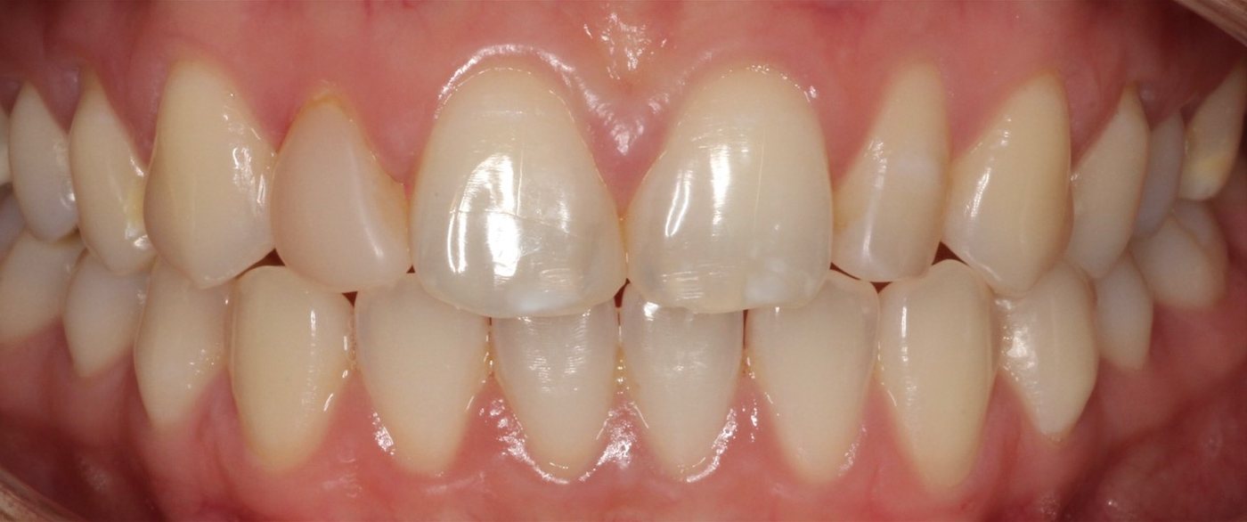Teeth before veneers and whitening