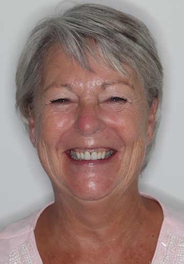 Small full-face view after treatment