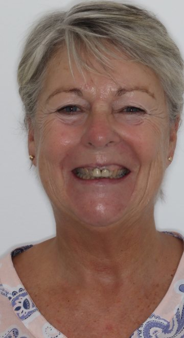 Small full-face view before treatment
