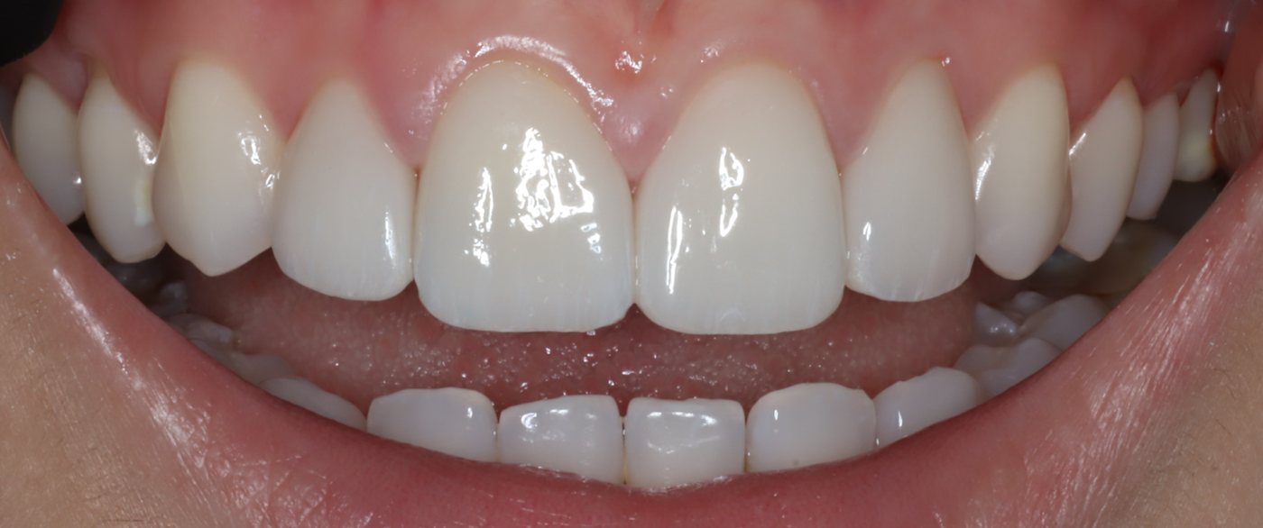 Smile after four ceramic veneers and whitening