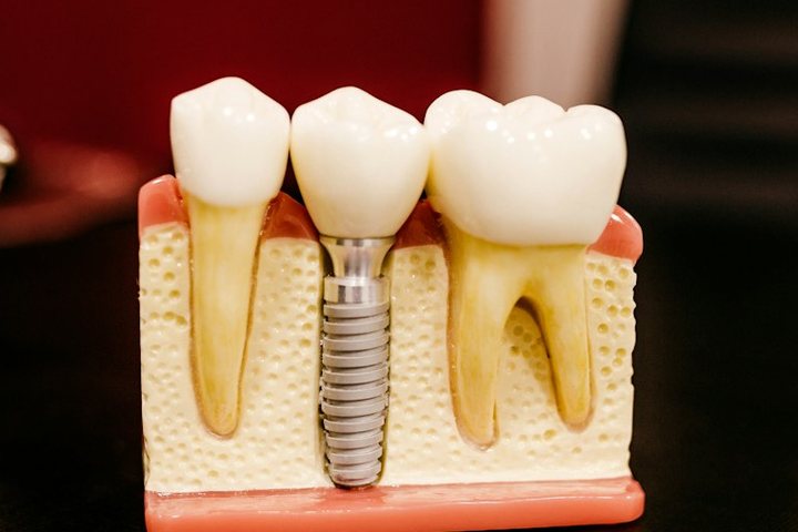 Model of the jaw showing a dental implant with a crown between two natural teeth