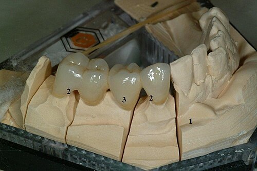 Dental bridge on a plaster model of the lower jaw