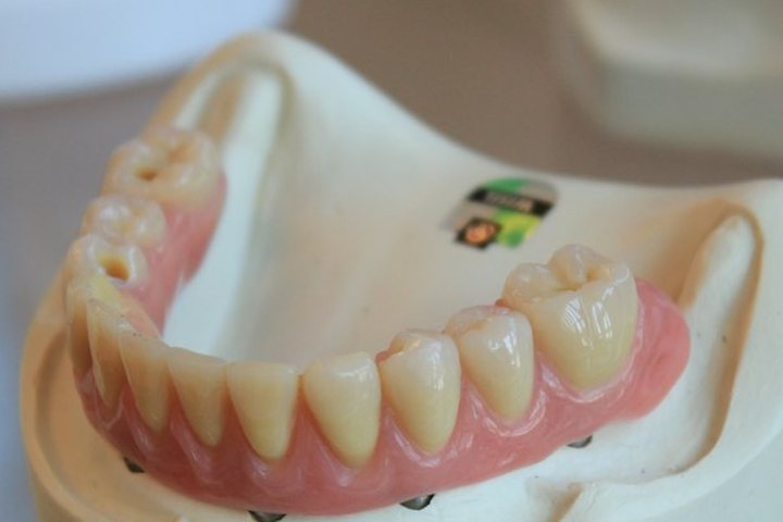 Lower denture on a plaster model of the jaw