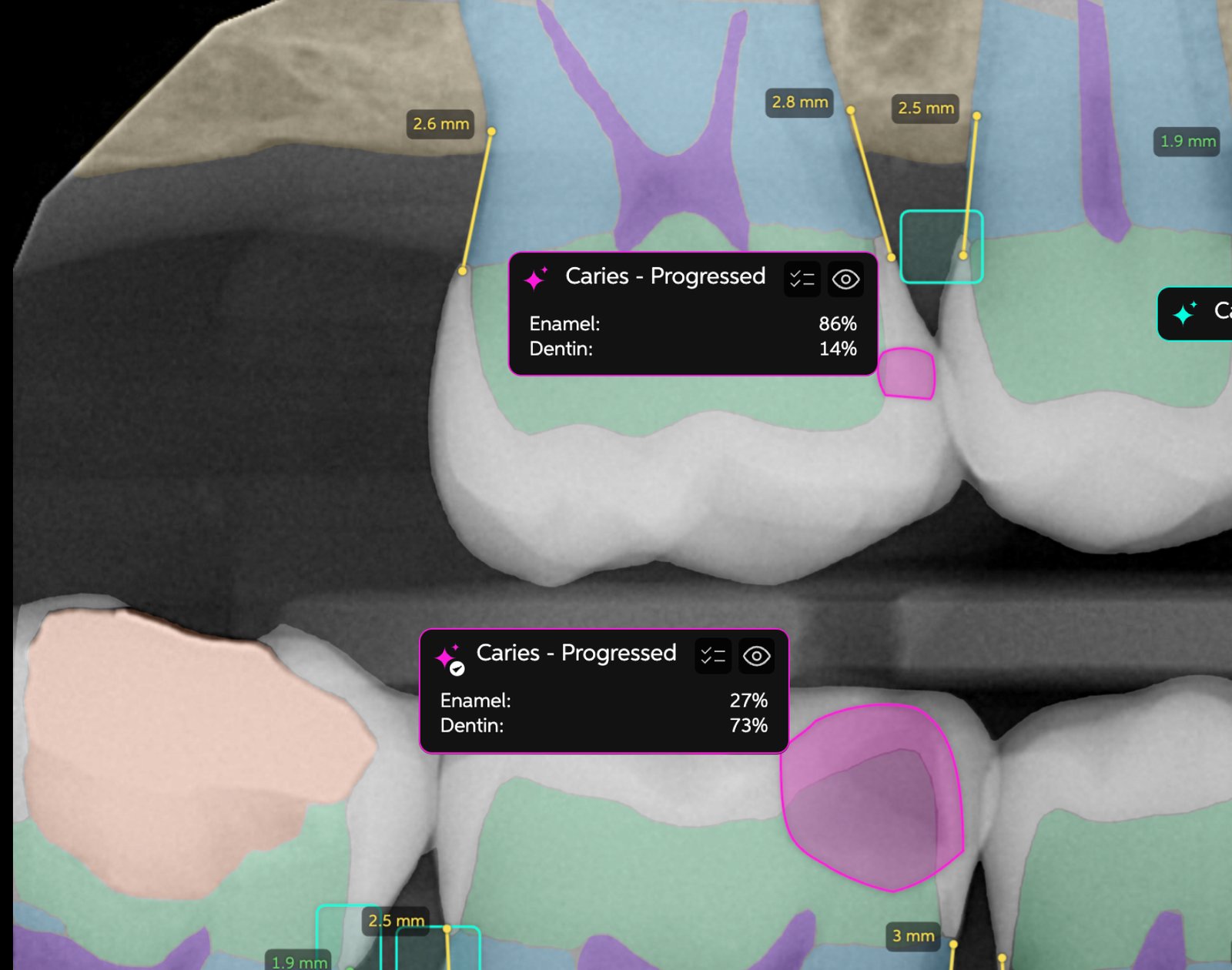 Example of Pearl AI colour-coded highlights on a dental X-ray, marking possible decay for the dentist to review