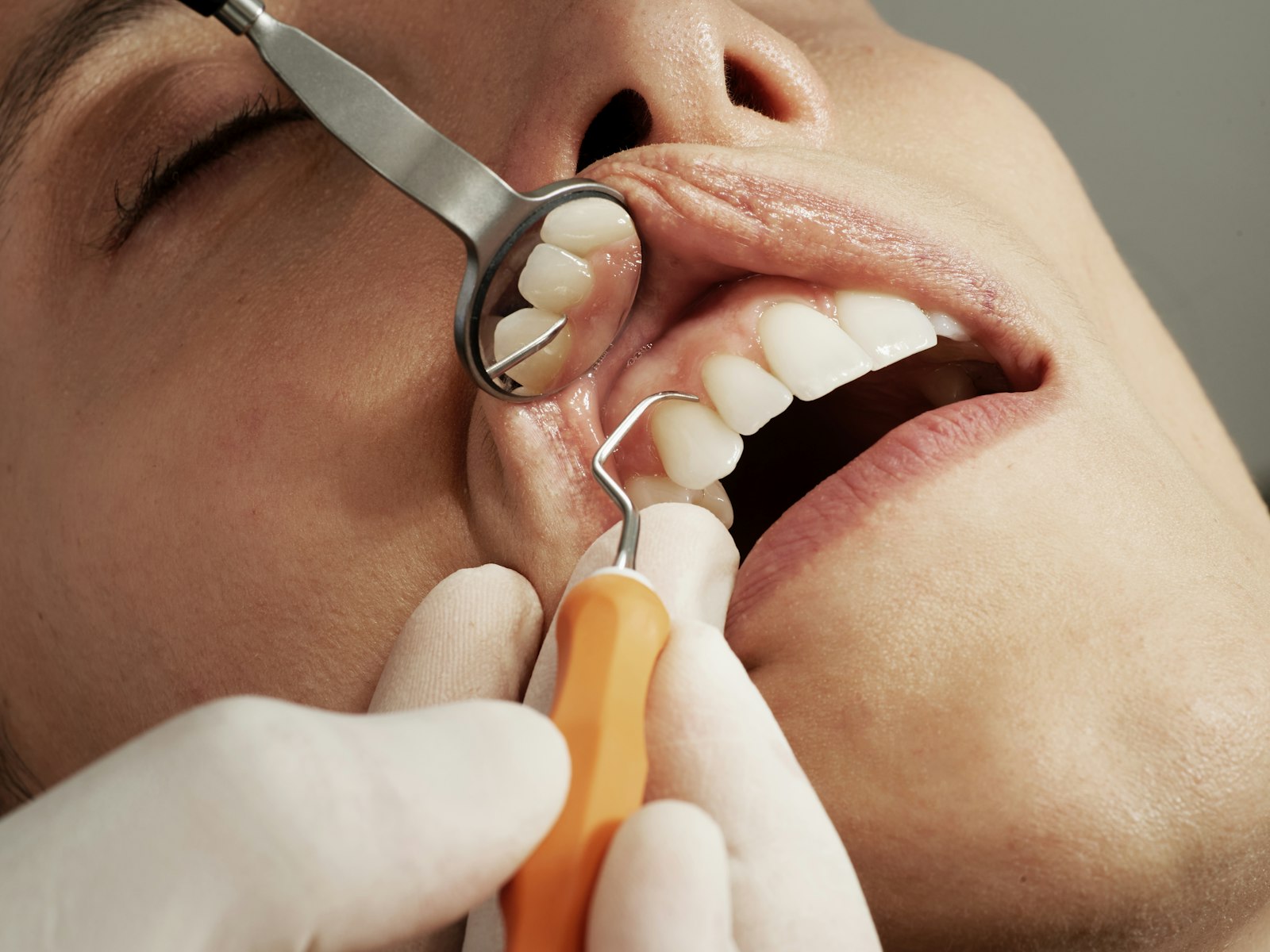 Sydney dentist performing a periodontal scale and root plane treatment for gum disease