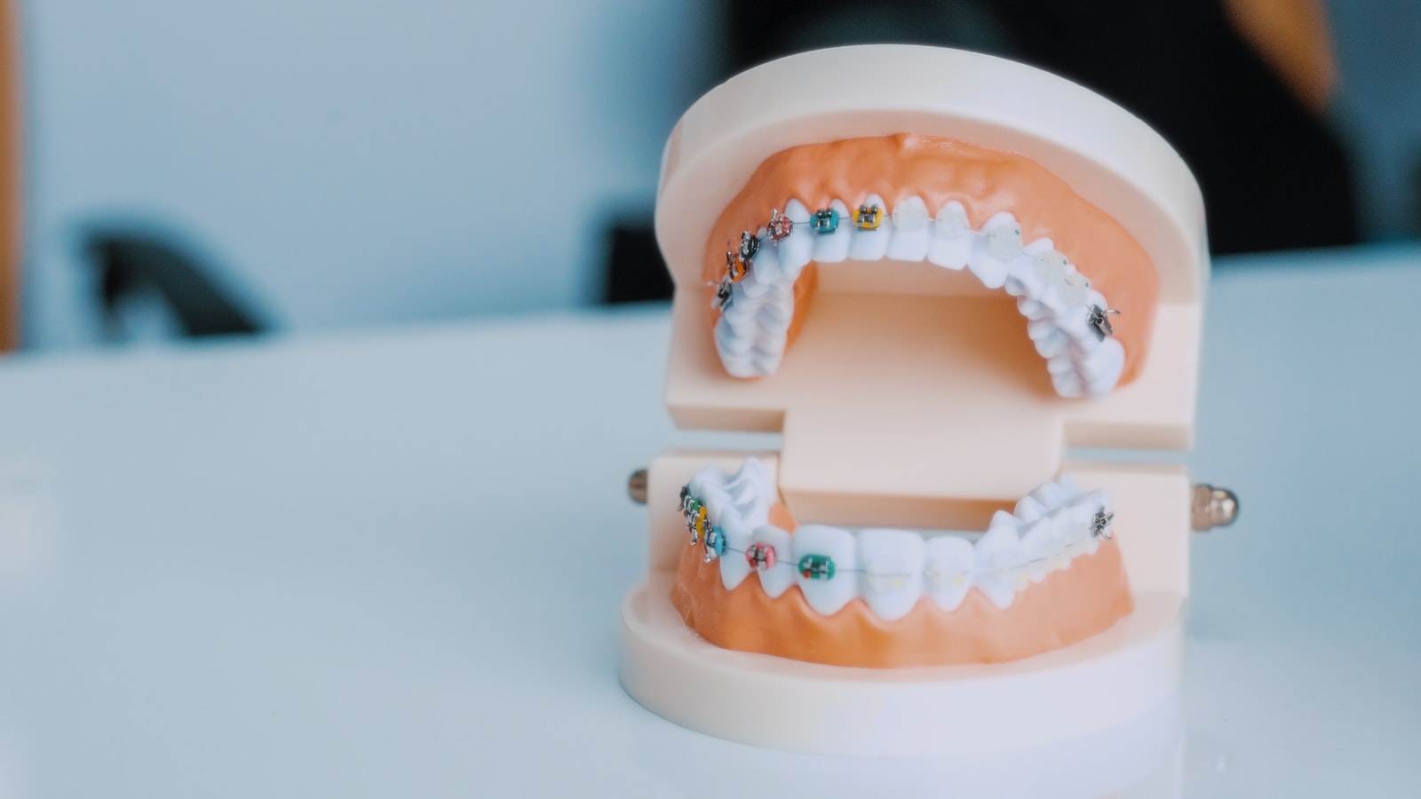 Dental tooth model on a wooden table showing crown and filling restorations, used to explain inlay vs onlay vs crown options in Sydney